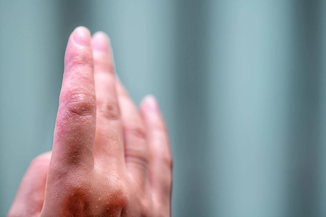reakcja alergiczna na nikiel