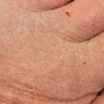 sucha skóra na dłoni