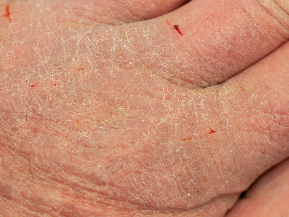 sucha skóra na dłoni