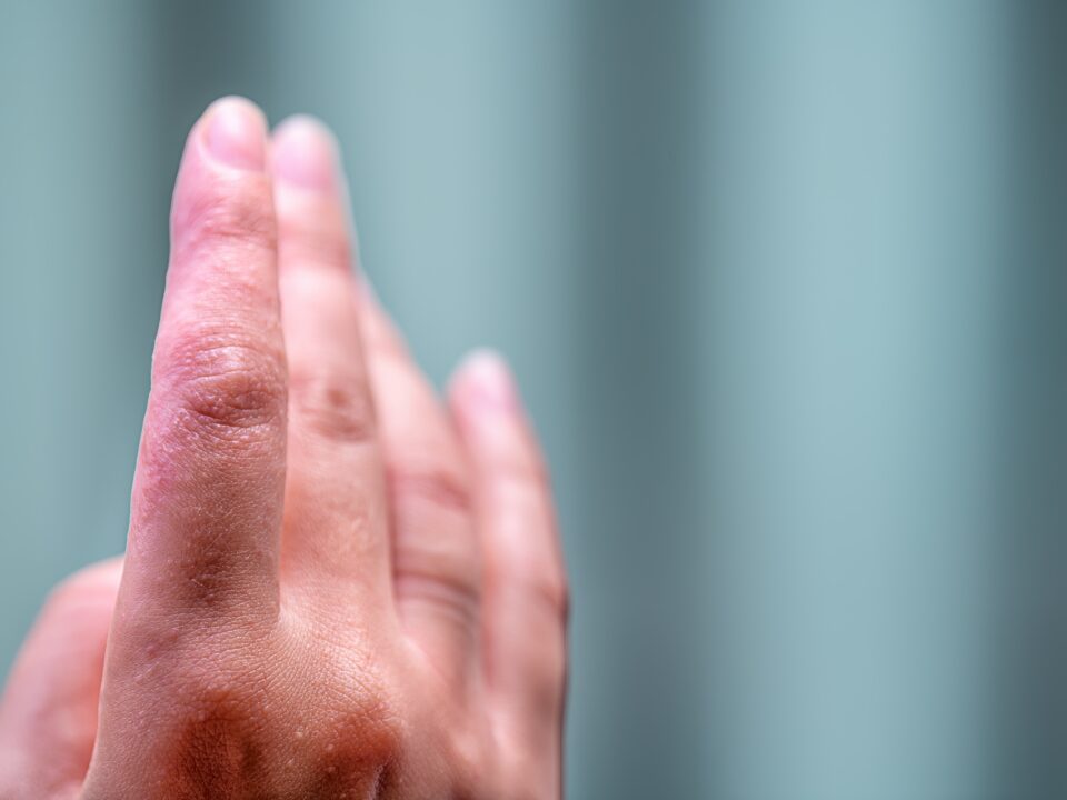 reakcja alergiczna na nikiel